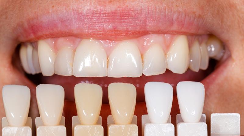 Dental Veneers in Philadelphia