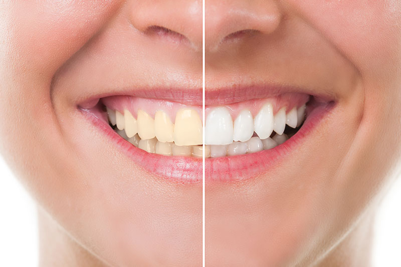 Professional Teeth Whitening in Plano