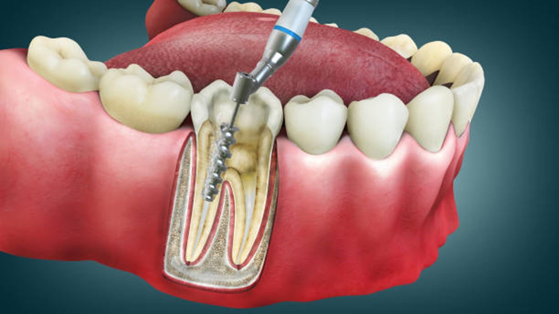 Root Canal Journey