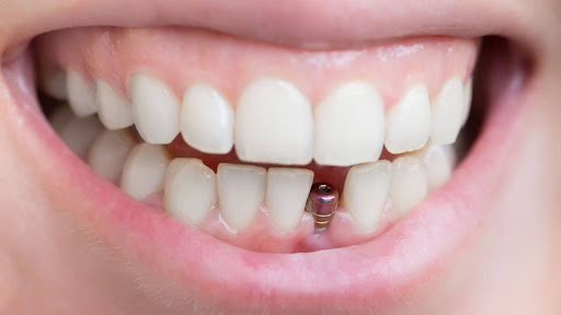 Key Factors That Determine Your Implant Eligibility